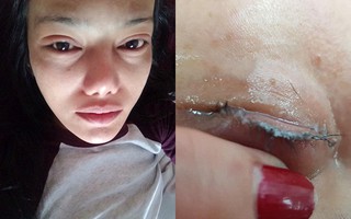 Dân mạng hoảng hốt với cô gái có đôi mắt sưng húp, rụng sạch cả lông mi vì nối bằng keo dán sắt