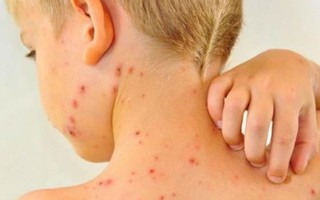 Hà Nội: Số ca mắc sốt xuất huyết giảm nhưng mắc bệnh sởi lại tăng