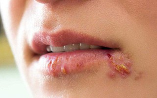 Các triệu chứng Herpes ở phụ nữ không nên bỏ qua