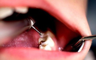 Nghiên cứu mới này sẽ khiến bạn không bao giờ dám quên đánh răng nữa
