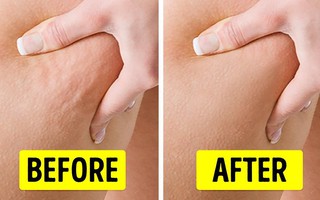 Da xấu xí vì sần sùi, lồi lõm như vỏ cam do mô mỡ tích tụ dưới da: Chị em làm ngay cách này để xử lý