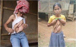 Con gái sinh ra với cánh tay thừa trước ngực, bà mẹ nghĩ rằng con bị dị tật không ngờ đó là "cơ thể người em song sinh"