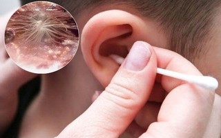 Con bị ngứa tai, đưa đi khám mẹ sốc khi bác sĩ thông báo có cây mọc trong tai