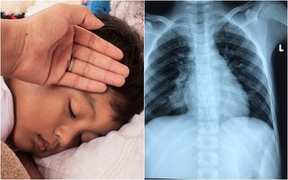 Tưởng là lao phổi nhưng khi chụp CT, bác sĩ phát hiện bé 11 tuổi suýt tử vong vì căn bệnh hiếm gặp