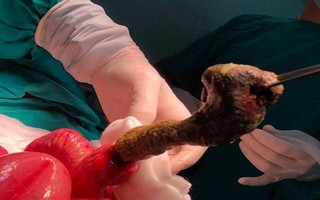 Bé gái 6 tuổi ở Đồng Nai mắc hội chứng "công chúa tóc mây" kỳ lạ, tự ăn tóc của mình dẫn đến tắc ruột