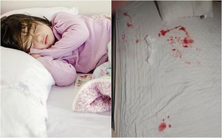 Mẹ hoảng hồn khi phát hiện máu trào ra từ miệng con gái đang ngủ