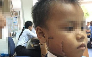 Đưa con đến lò gạch làm việc, cha mẹ khóc ngất vì bé gái 6 tuổi bị cánh quạt chém thấu xương hàm nguy kịch