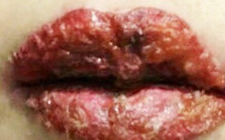 Bác sĩ Da liễu: Xăm môi thẩm mỹ “vườn” dễ rước bệnh HIV, viêm gan B