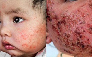 Dùng sữa mẹ chữa chàm sữa cho con, bệnh không khỏi mà da con còn bị tổn thương nặng