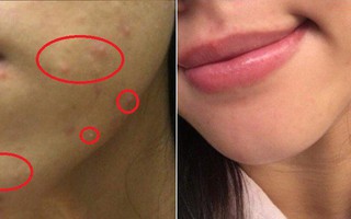 Da đầy mụn mẩn đỏ li ti, cô gái này đã thay đổi hoàn toàn nhờ chu trình dưỡng với 4 bước cơ bản