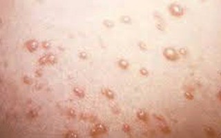 Những dấu hiệu mắc bệnh lây qua đường tình dục dễ bị bỏ qua