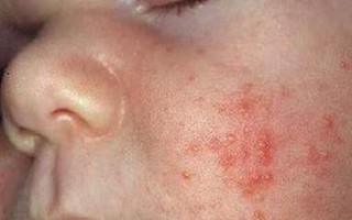 Chuyên gia bày cách hết ngứa ngáy do bệnh viêm da cơ địa