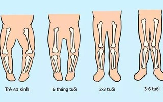 Chỉ mất vài giây để nhận biết chính xác trẻ có mắc tật chân vòng kiềng hay không và cách phòng tránh hiệu quả