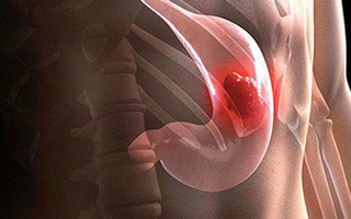 Những dấu hiệu "âm thầm" không gây đau đớn của bệnh ung thư dạ dày