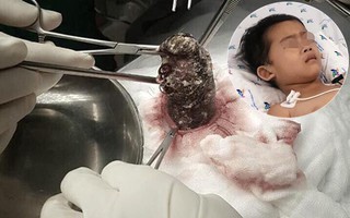 Bé gái 6 tuổi suốt 3 năm trời ăn thứ này, khi bác sĩ mổ ruột mới thật sự choáng váng