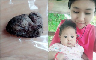 2 tháng sau khi sinh thường, sản phụ hốt hoảng khi thấy vật thể lạ trôi ra từ cơ thể khi đi vệ sinh
