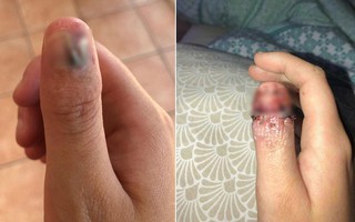 Cô gái 20 tuổi đã bị bệnh ung thư cực nguy hiểm do ngày nào cũng làm việc mà rất nhiều người vẫn làm vì tưởng là vô hại 