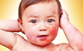 Cứ tới Tết là trẻ dễ bị dị ứng với những món lạ và đây là 4 tuyệt chiêu xử lý nhanh cắt cơn mẩn ngứa
