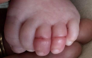 Thêm 1 bé sơ sinh suýt mất 2 ngón chân chỉ vì sợi tóc của mẹ