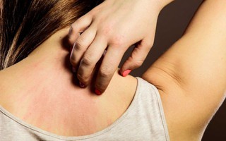 8 cách đơn giản phòng ngừa bệnh về da chàm eczema trong mùa đông