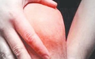 Hoại tử nửa người vì tự làm bác sĩ chữa gout