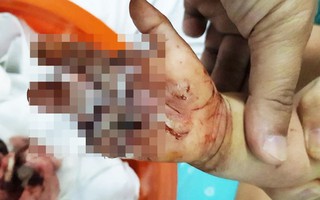 Bình Dương: Bé trai 2 tuổi bị sên xe máy quấn đứt lìa bàn tay