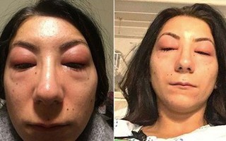 "Nghiện" nối mi giả cô gái rước họa với đôi mắt sưng phù không mở ra được