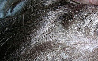 Những nguyên nhân không ngờ gây ra tình trạng nấm da đầu mà nhiều người không hề nghĩ tới