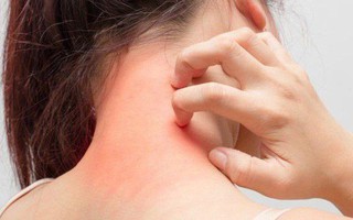 Da bị mẩn đỏ, ngứa ngáy là dấu hiệu cảnh báo những vấn đề sức khỏe gì?