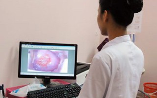 Lộ tuyến cổ tử cung có gây ung thư?