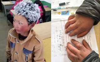 Sau 1 năm khiến cả thế giới xúc động, cuộc sống của cậu bé "tóc đóng băng" đáng thương giờ ra sao?