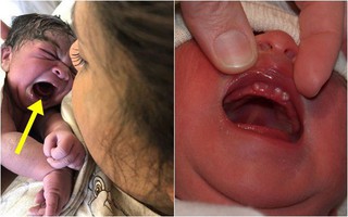 Con vừa cất tiếng khóc chào đời, mẹ ngỡ ngàng không tin nổi vào mắt mình khi thấy "vật thể lạ" trong miệng bé