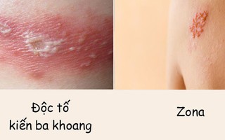 Phân biệt vết thương do kiến ba khoang với viêm da do zona để tránh dùng sai thuốc khiến bệnh càng khó chữa
