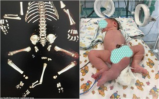 Bé trai sinh ra với 3 chân, 2 dương vật, không hậu môn được cứu sống một cách kì diệu khiến nhiều người cảm động