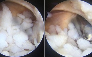 Đắp lá trị vết thương, chàng trai không ngờ có hàng trăm viên sỏi nhỏ màu trắng trong khớp khuỷu tay