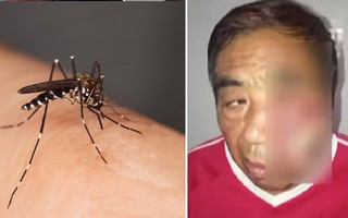 Đêm ngủ bị muỗi đốt, chỉ vì làm việc này mà người đàn ông bị nhiễm trùng, hoại tử tận xương, suýt mất mạng