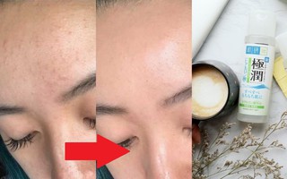 Cô gái biến làn da sần sùi, lấm tấm mụn thành mịn mướt chỉ sau 4 ngày với toàn những sản phẩm rẻ tiền dễ mua