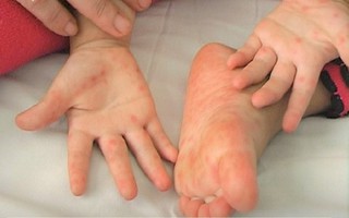 Biến chứng của bệnh tay chân miệng có thể gây tử vong, cha mẹ đừng bỏ qua những dấu hiệu cảnh báo nguy cơ biến chứng như này