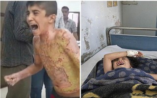 Dư luận quốc tế chấn động trước một loạt hình ảnh trẻ em Syria với những vết bỏng nặng, khoét sâu vào cơ thể do vũ khí hóa học gây ra