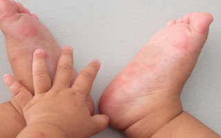 Những việc cha mẹ nào cũng nên làm để phòng bệnh tay chân miệng cho con