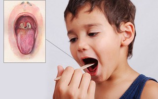 Quãng Ngãi ghi nhận 8 trường hợp mắc bệnh bạch hầu và 1 trường hợp tử vong: Bệnh bạch hầu lây truyền qua đường nào?
