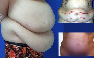 Hút hơn 3,5 lít mỡ đặc và cắt hơn 3kg da thừa, thu nhỏ thành bụng siêu khủng cho bệnh nhân nữ nặng 90kg