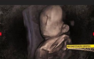 Em bé sinh ra khiếm khuyết hàng loạt bộ phận mặc dù mang thai mẹ đi siêu âm đầy đủ