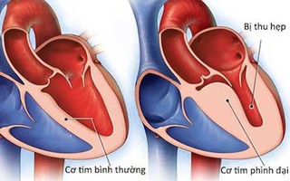 Viêm cơ tim - Một số điều bệnh nhân cần biết: Khi nào thì cần đi khám và những xét nghiệm cần thực hiện 