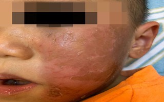 Nguy hiểm: Bé trai 4 tuổi bỏng rộp mặt sau khi đeo mặt nạ siêu nhân chơi Halloween