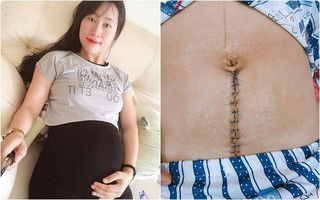 Mẹ 9x kể 3 lần mang thai đều phải nằm bất động trên giường, nhìn vết mổ đã thấy "đau như chết đi sống lại"