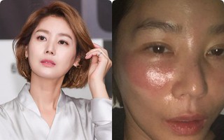 Đắp mask quá lâu, "mẹ Kim Tan" nhận ngay cái kết đắng, làn da rát đỏ sưng tấy ai nhìn cũng xót
