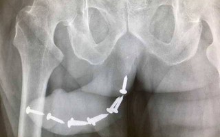 Người đàn ông cấy gần chục chiếc đinh vít vào của quý để tăng khoái cảm và cái kết không lường trước