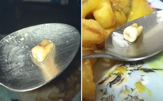 Cặp đôi đệ đơn kiện nhà hàng Trung Quốc vì tìm thấy nguyên chiếc răng sâu trong đồ ăn take-away