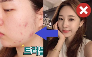 Mùa Đông, da bạn dễ xấu nhức nhối và nổi mụn tùm lum vì 5 sự lơ đễnh này 